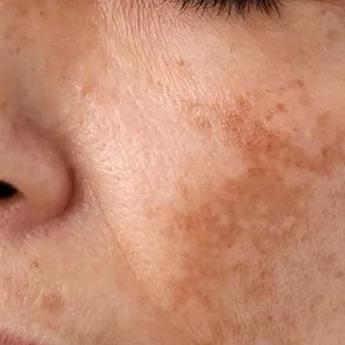 Foto ilustrativa: melasma